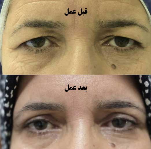 بلفاروپلاستی