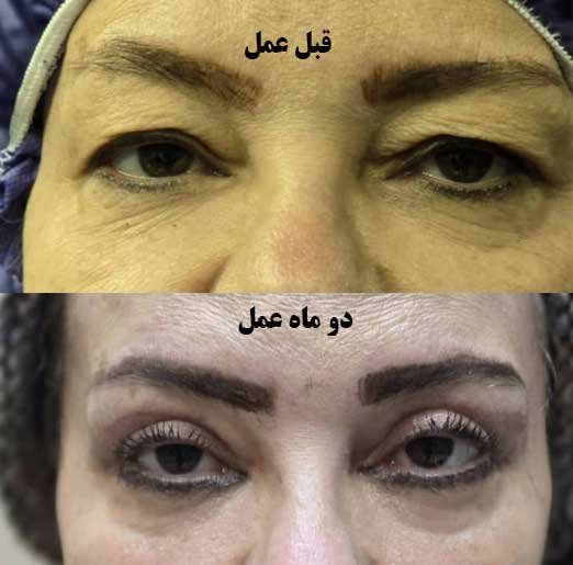 بلفاروپلاستی